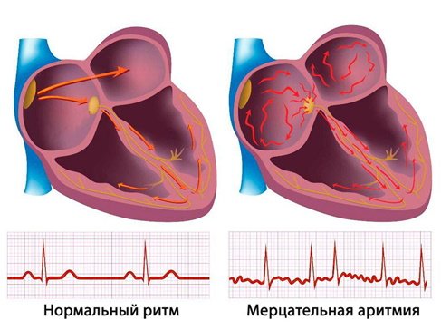 Аритмия сердца