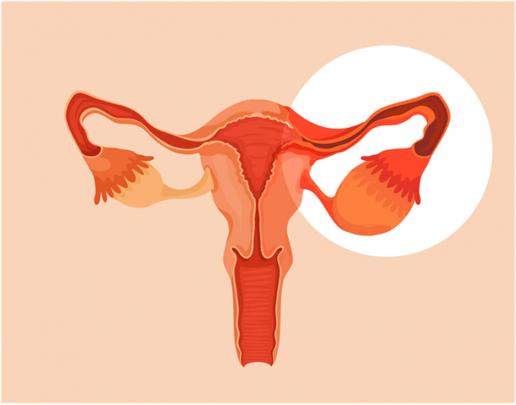 Эндометрит: симптомы и лечение у женщин — статья МЦРМ