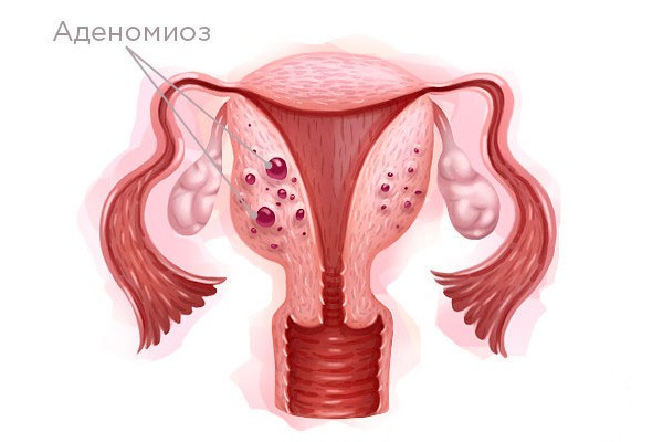 Аденомиоз матки. Диагностика и лечение аденомиоза матки в Москве – клиника гинекологии Гинеко