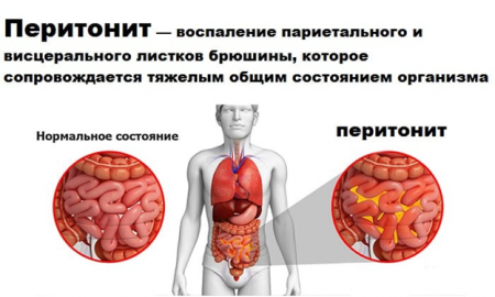 Перикоронит зуба мудрости: основные симптомы и принципы лечения